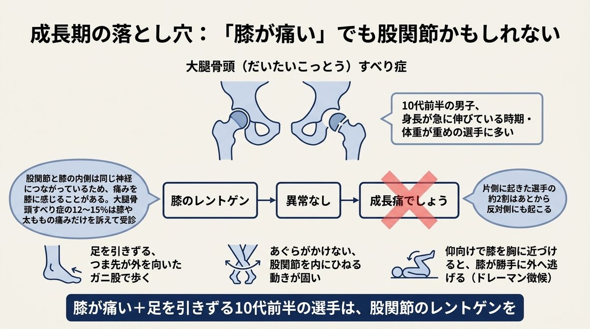 大腿骨頭すべり症の見逃しを防ぐための図解。正常な股関節と、成長軟骨の部分で大腿骨頭がずれた股関節の模式図。股関節と膝の内側は同じ神経につながっているため膝に痛みを感じることがあり、すべり症の12〜15%は膝や太ももの痛みだけで受診する。膝のレントゲン、異常なし、成長痛でしょう、という見逃しの流れに×印。10代前半の男子、身長が急に伸びている時期や体重が重めの選手に多く、片側に起きた選手の約2割はあとから反対側にも起こる。疑うサインは、足を引きずるガニ股歩行、あぐらがかけない、仰向けで膝を胸に近づけると膝が外へ逃げる（ドレーマン徴候）の3つ。